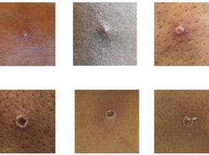 Auspr&auml;gungen von Hautausschlag bei den Affenpocken